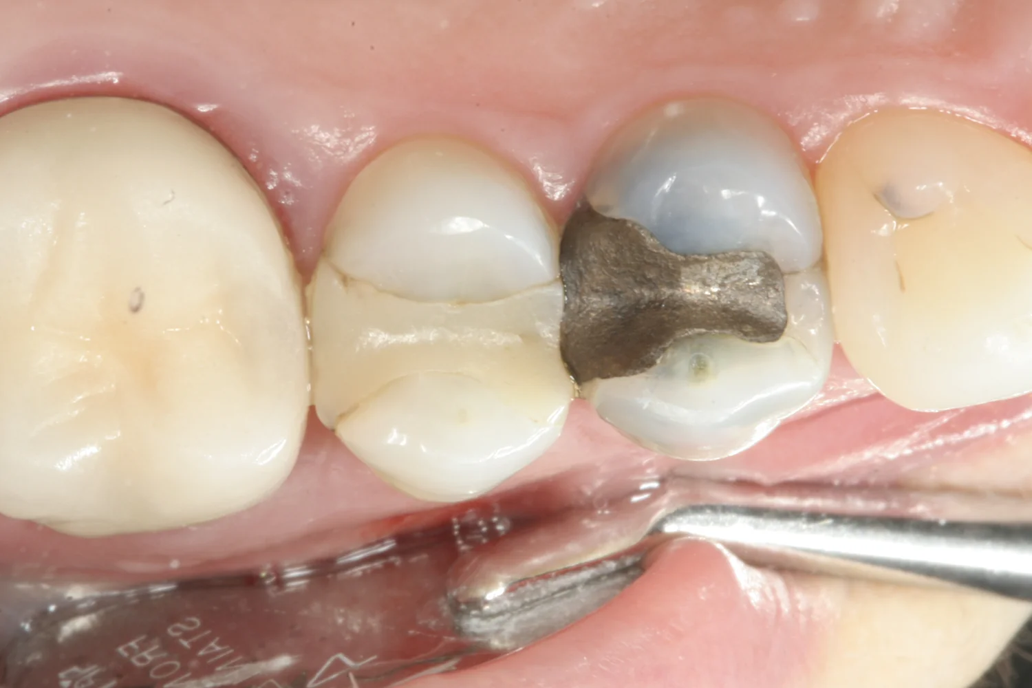 Biting surfaces of upper back teeth. The tooth with the silver filling has a crack running through it and down the side of the tooth to the gum line.