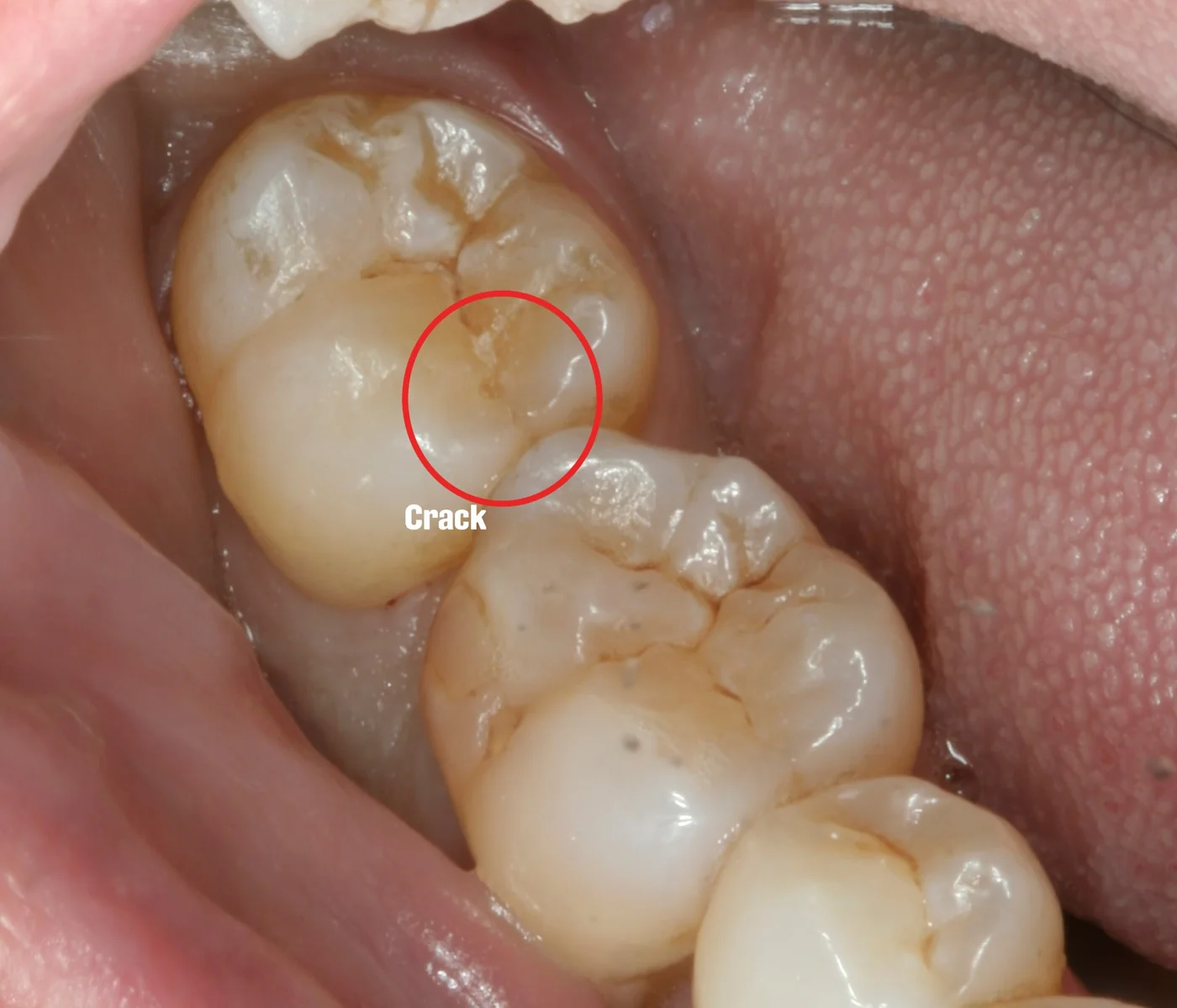 Biting surface of a lower back tooth with a crack running through it, circled in red and labeled Crack.