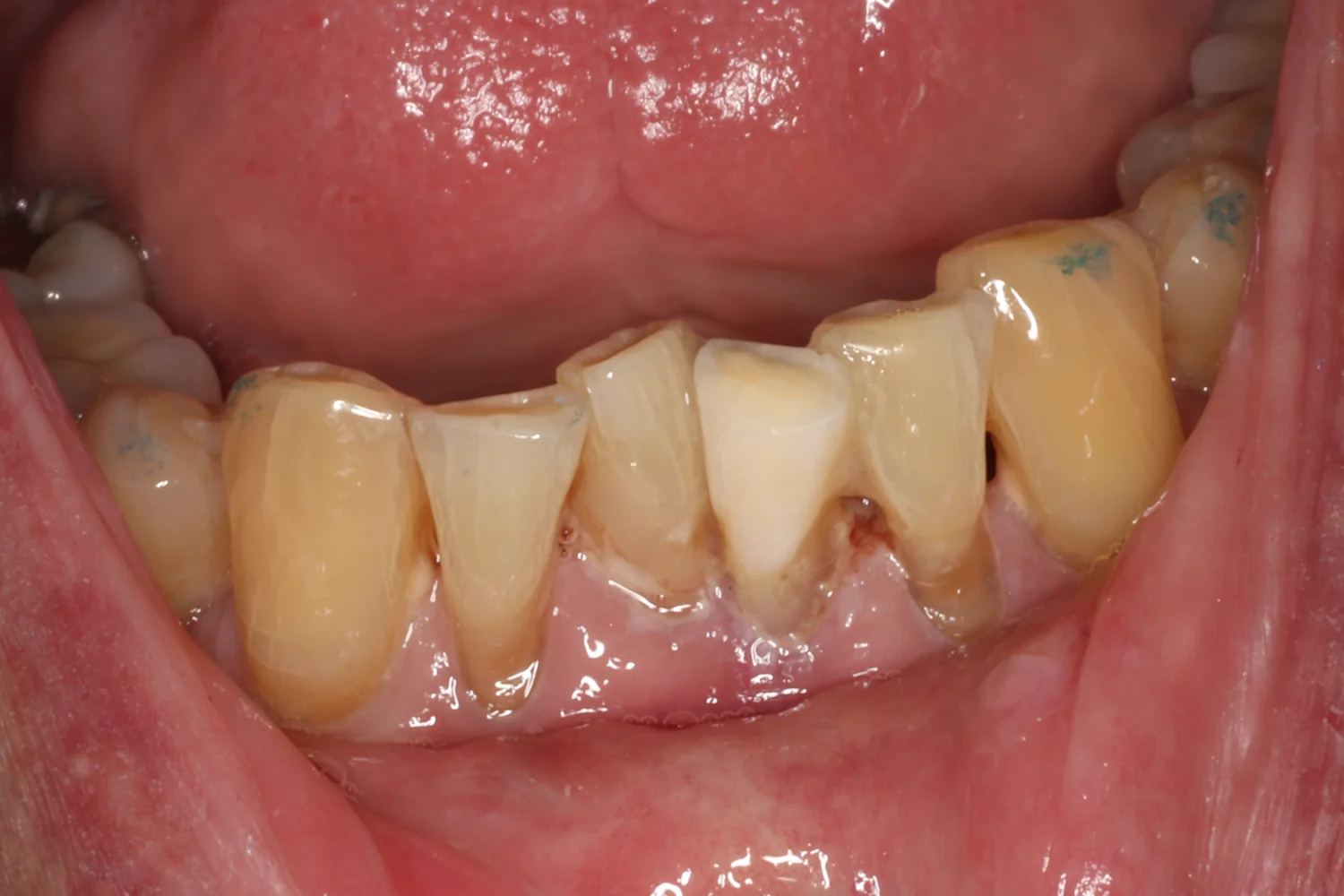 Crowded, overlapping lower front teeth with buildup and gum irritation where they overlap.