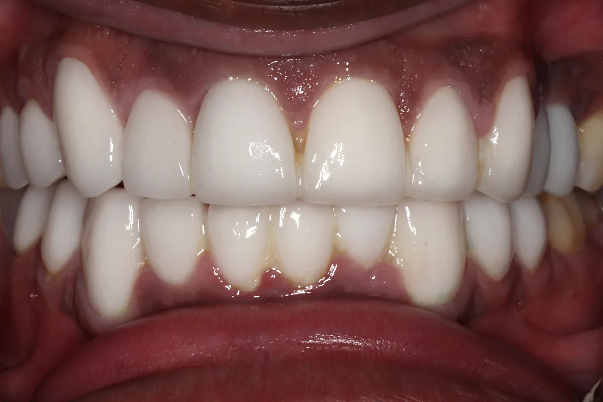 Retracted view of the closed bite: upper and lower front teeth restored with very white crowns joined together across the teeth, done in Europe.