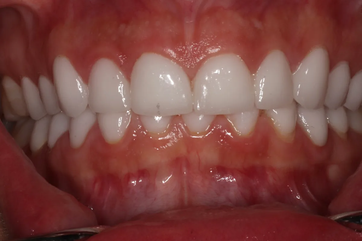 Retracted view of upper and lower teeth restored with very white crowns joined together, done in Turkey.