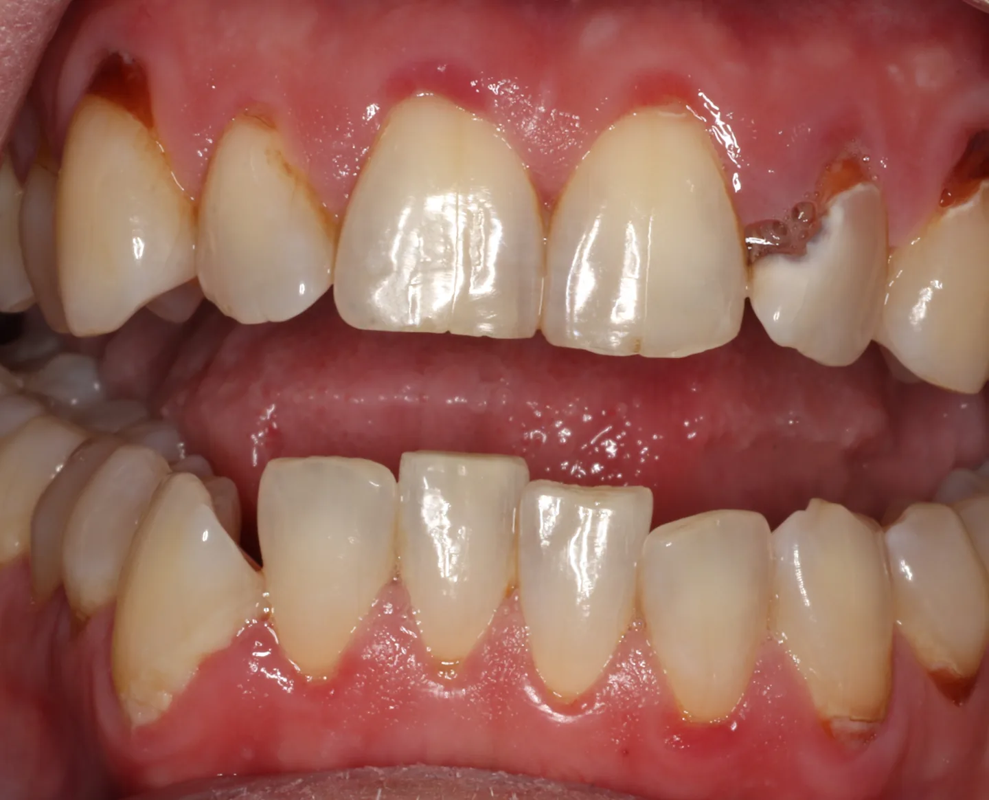 Retracted view of upper and lower teeth showing brown decay following the gumline across several teeth at once, with recession, inflamed gums and a broken-down upper tooth.