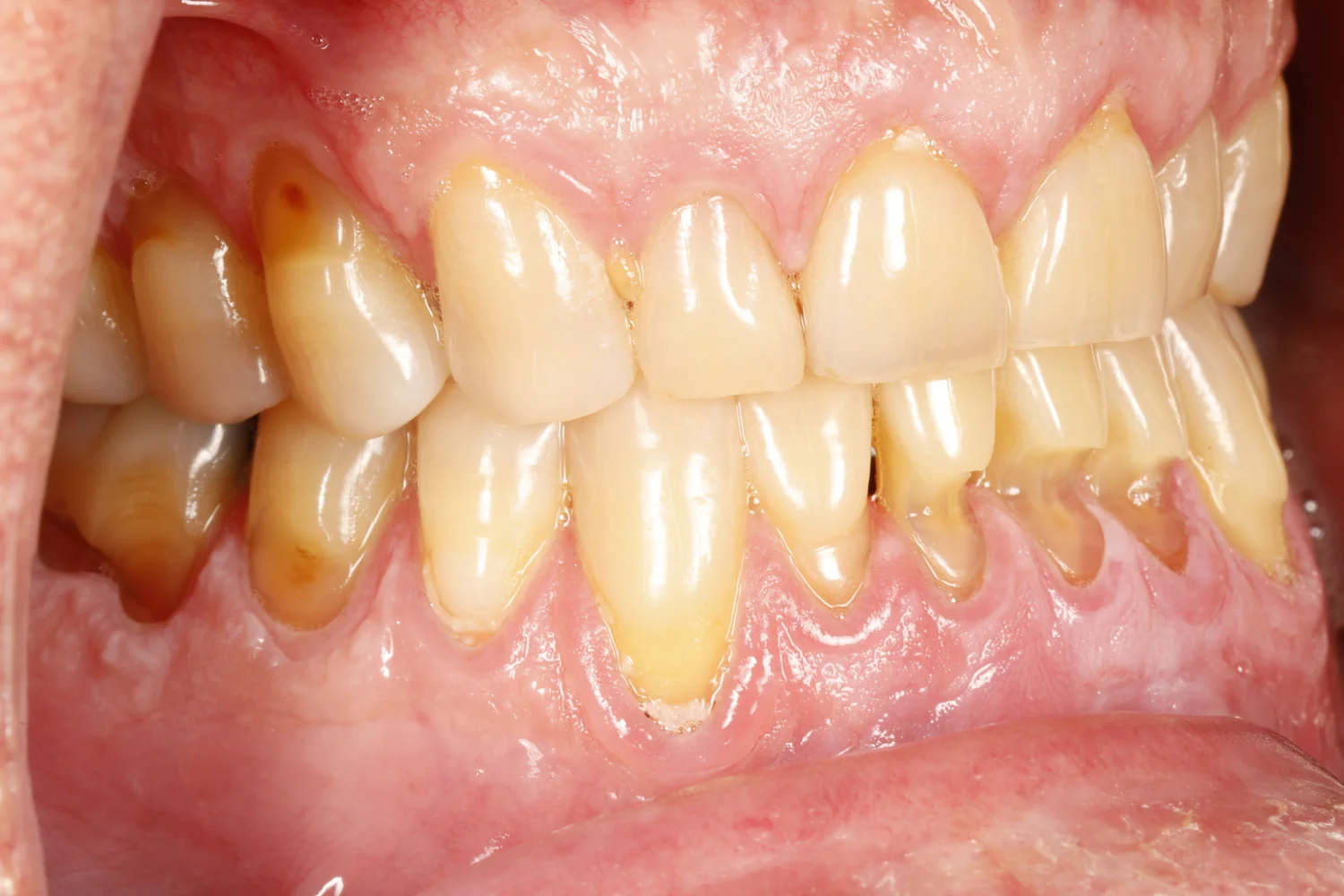 Close-up of upper and lower teeth. The gums on the lower teeth have pulled back, and several lower teeth have notches worn into them right at the gum line.