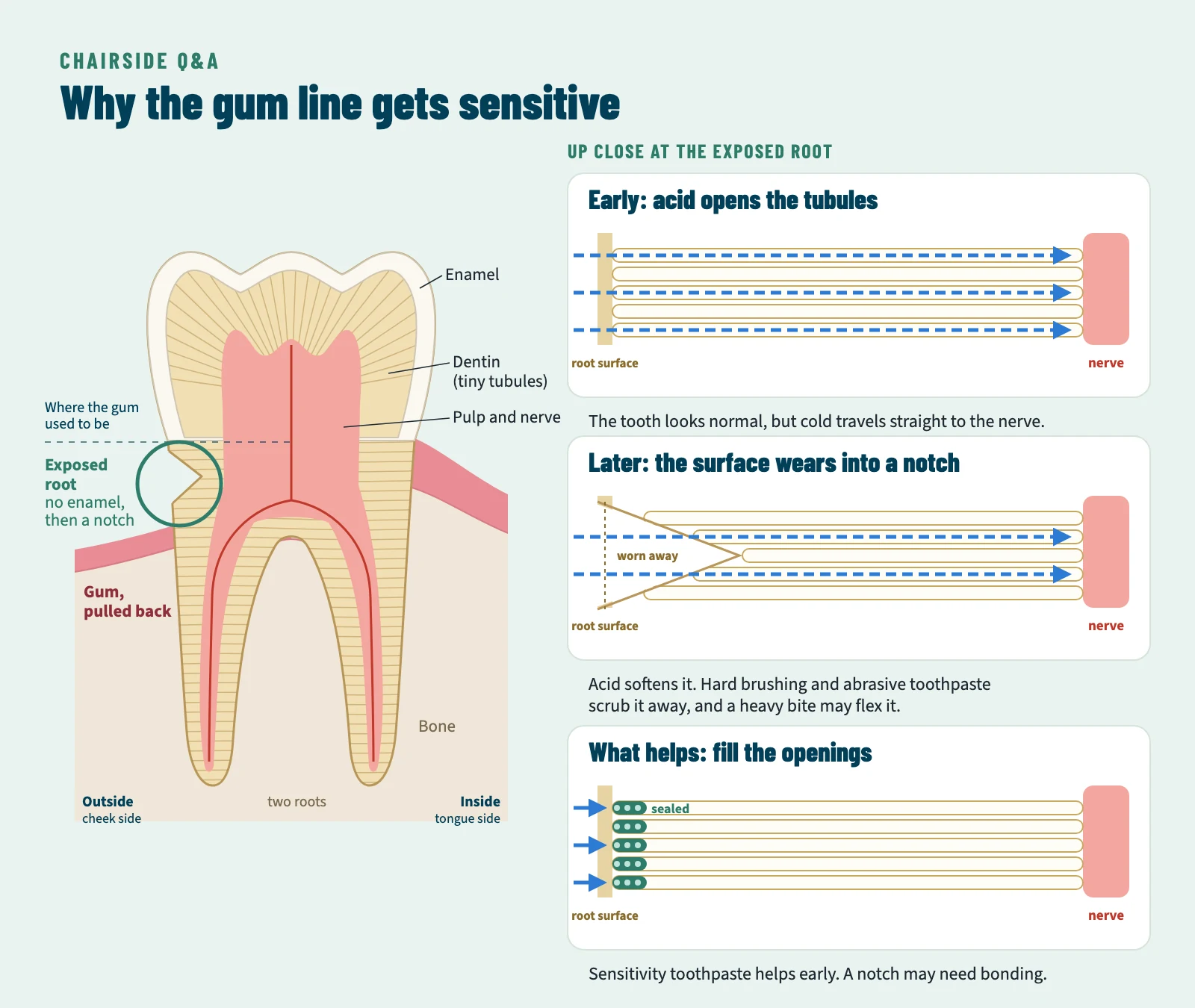 Diagram of a lower molar. On the outside of the tooth the gum and bone have pulled back, exposing root with no enamel, and a notch has formed at the gum line. Three close-up panels: early, acid opens the tubules so cold reaches the nerve; later, hard brushing and abrasive toothpaste wear the softened surface into a notch; and sensitivity toothpaste plugging the tubule openings.