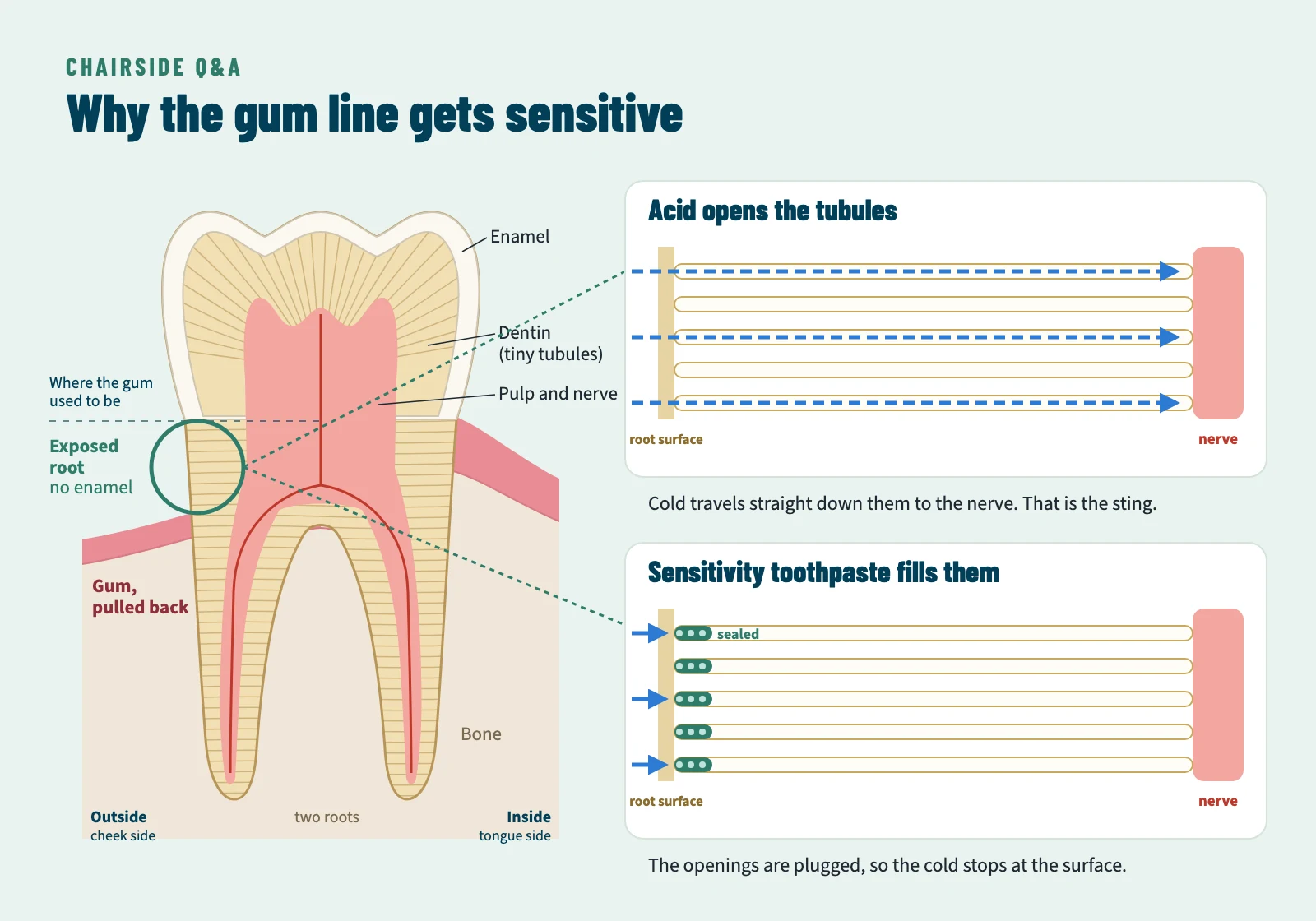 Diagram of a lower molar. On the outside of the tooth the gum and bone have pulled back, exposing root with no enamel. Two close-up panels: acid opens the tiny tubules in the root so cold travels to the nerve, and sensitivity toothpaste plugs the openings so the cold stops at the surface.