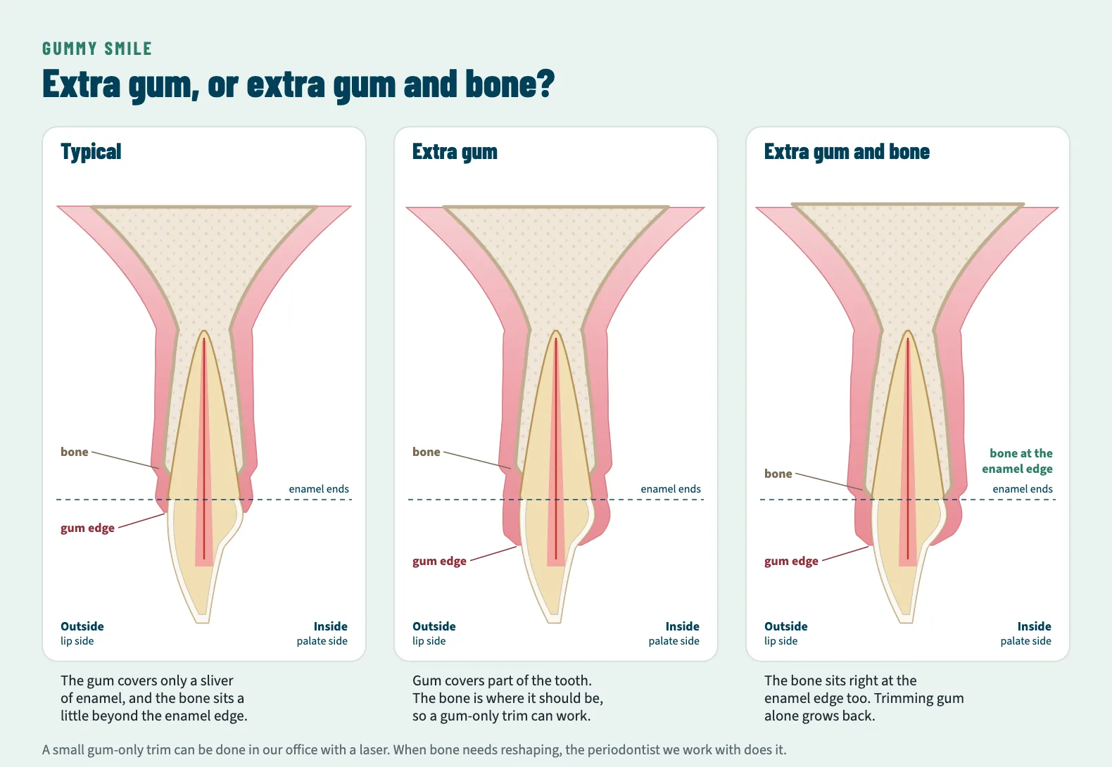 Three cross-sections of an upper front tooth. First, typical: the gum covers only a sliver of enamel and the bone sits a little beyond the enamel edge. Second, extra gum: gum covers part of the tooth but the bone is in its normal place. Third, extra gum and bone: the gum covers part of the tooth and the bone sits right at the enamel edge.
