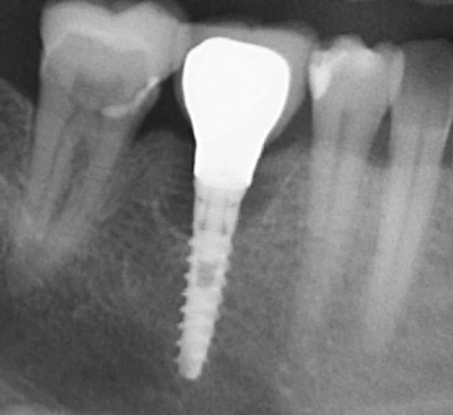 Dental X-ray of the same narrow, deep implant after a crown was placed on it abroad.