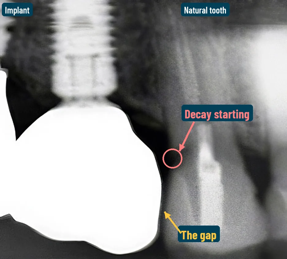 Dental X-ray of an implant crown next to a natural tooth, with a dark gap between them and early decay on the natural tooth beside the gap.