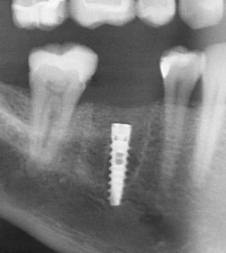 Dental X-ray of a lower jaw showing a narrow implant set deep in the bone between two teeth, with no crown on it yet.