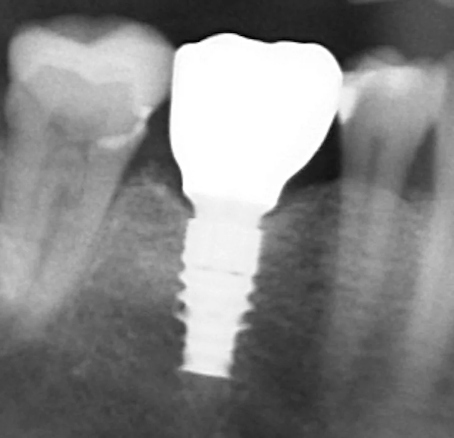Dental X-ray of a new, wider implant in the same spot with a new crown on it.
