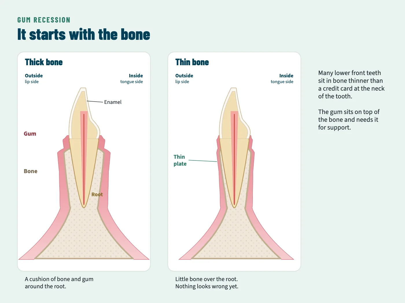 Two cross-sections of a lower front tooth in its bone. On the left, thick bone and gum surround the root on both sides. On the right, the bone on the lip side of the root is a thin plate.