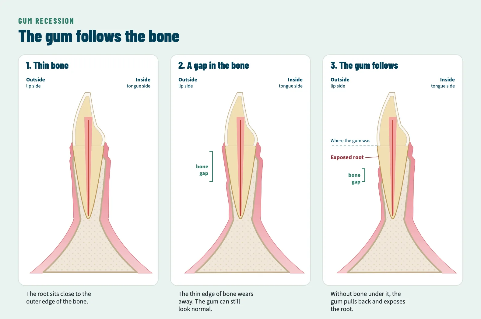 Three cross-sections of a lower front tooth. First, the root sits close to the outer edge of thin bone. Second, the thin edge of bone has worn away while the gum still looks normal. Third, the gum has pulled back down to the lowered bone, exposing the root.
