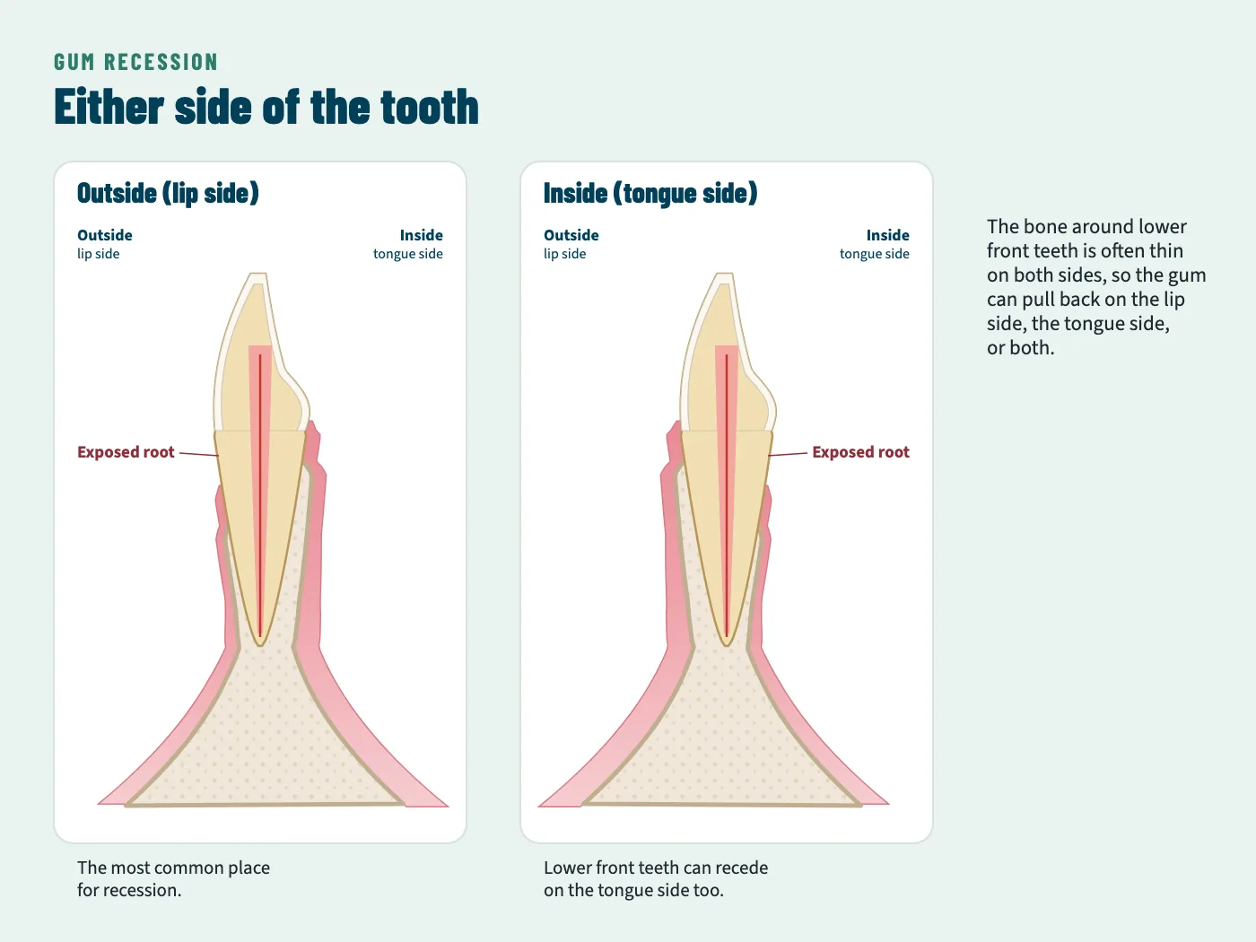 Two cross-sections of a lower front tooth. On the left, the gum has pulled back on the lip side, exposing the root. On the right, the gum has pulled back on the tongue side instead.