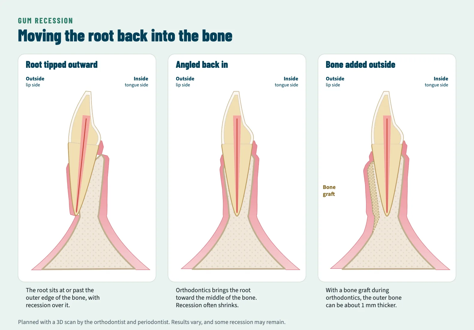 Three cross-sections. First, a lower front tooth whose root is tipped outward past the edge of the bone, with recession over it. Second, the root angled back toward the middle of the bone, with less recession. Third, the same tooth with a bone graft thickening the outer bone.
