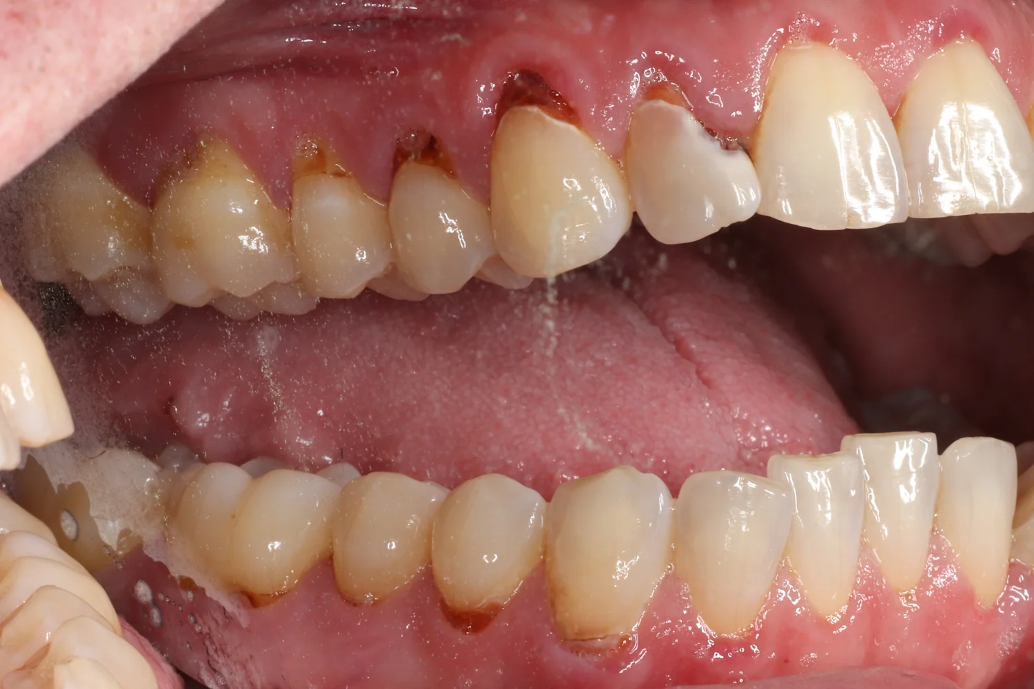 Side view of upper and lower back teeth. The gums have pulled back on several teeth, and there is dark brown decay on the exposed roots right at the gum line.