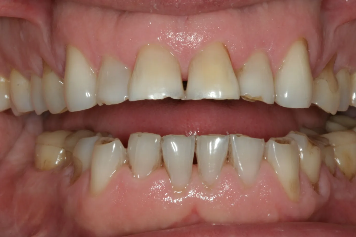 Retracted view of upper and lower front teeth with worn, uneven incisal edges and staining along the gumline.