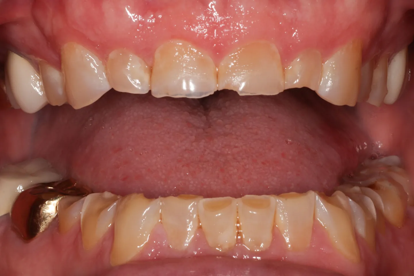 Retracted view of upper and lower teeth showing advanced wear. Crowned teeth and a gold restoration on one side retain their full height, while the natural teeth beside them show worn, cupped incisal edges with exposed dentin.