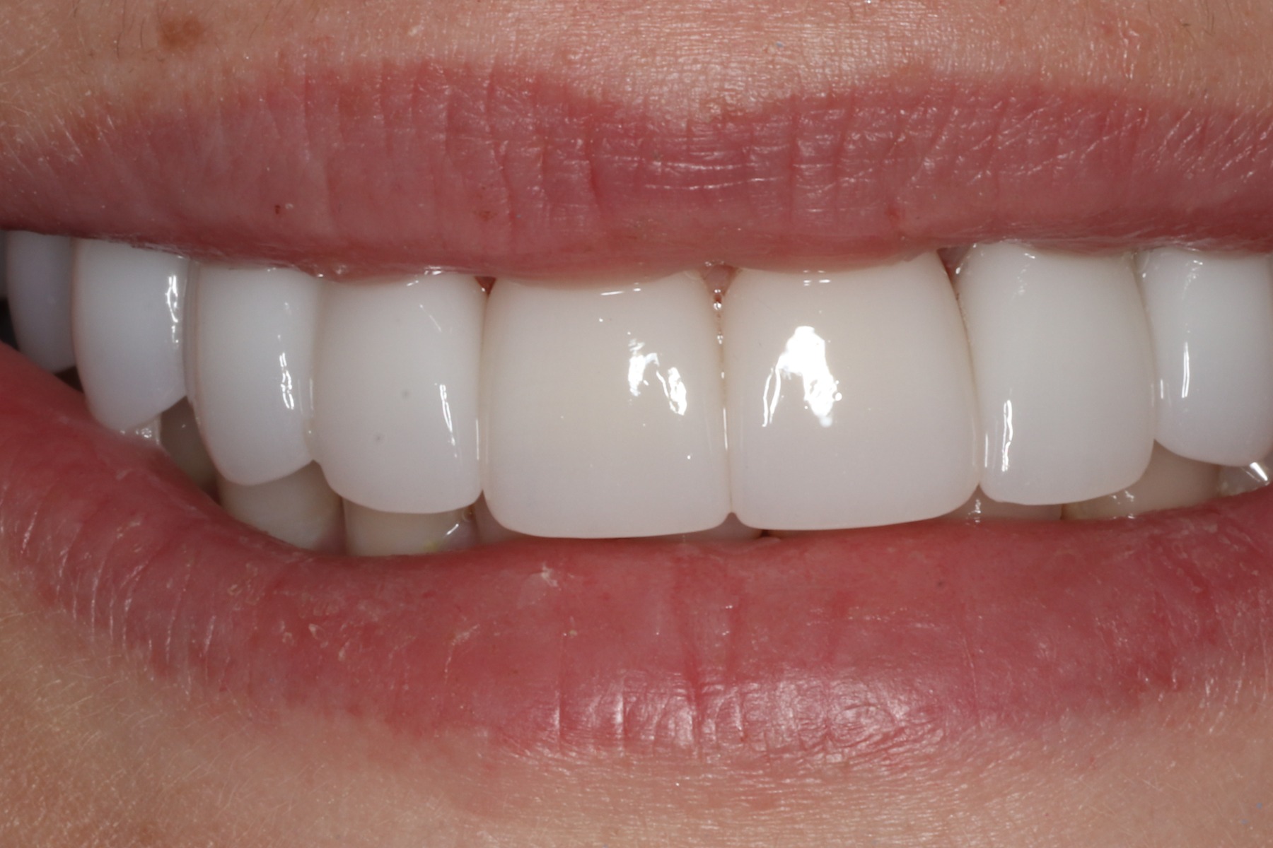After: B.R.'s smile restored