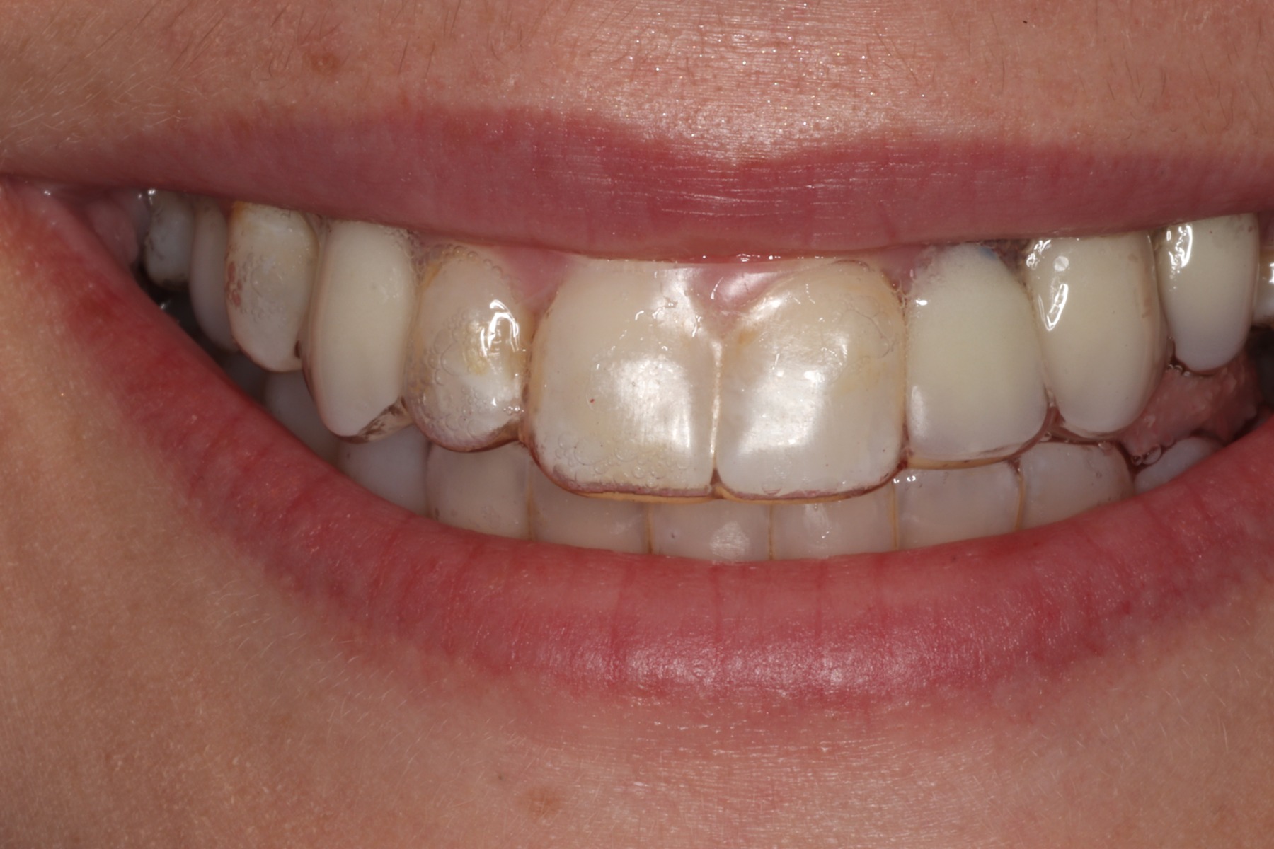 Before: B.R.'s smile