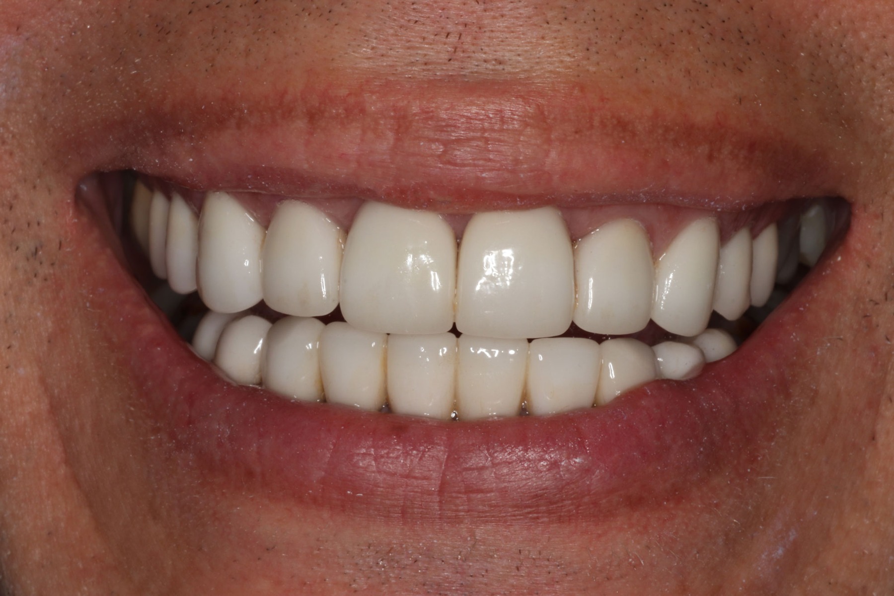 After: C.S.'s smile restored