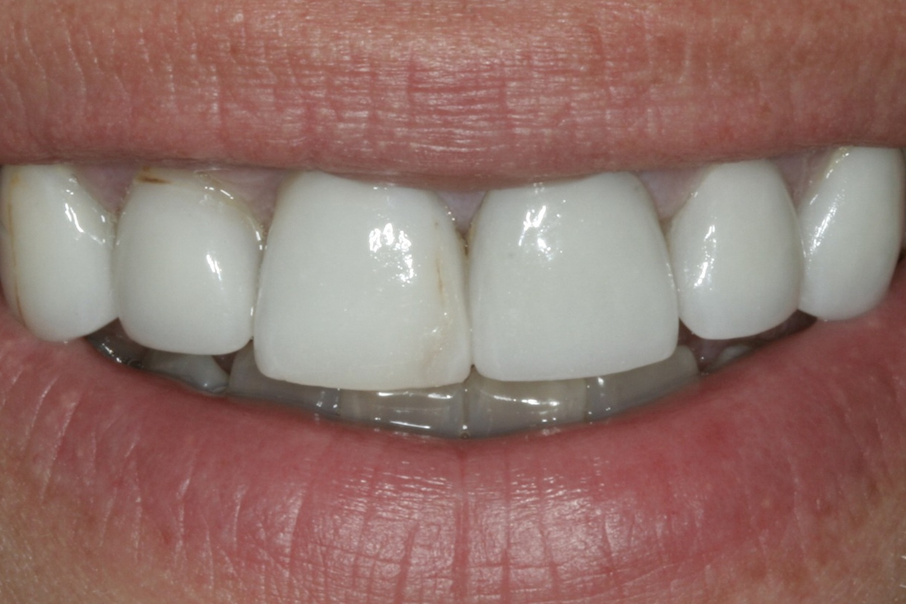 Before: C.S.'s smile