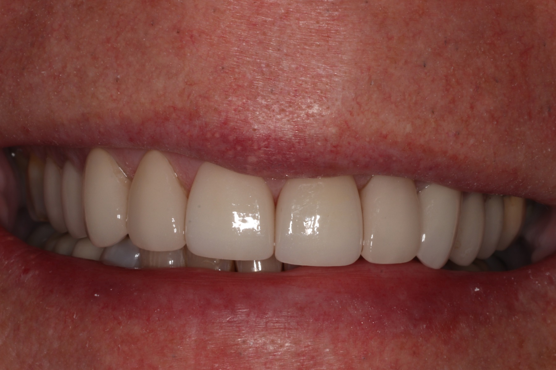 After: D.E.'s smile restored