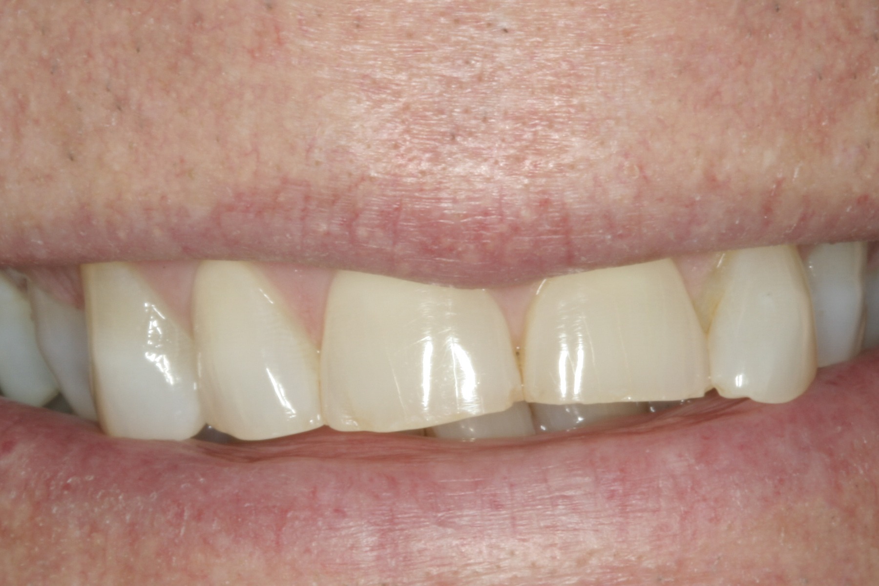 Before: D.E.'s smile
