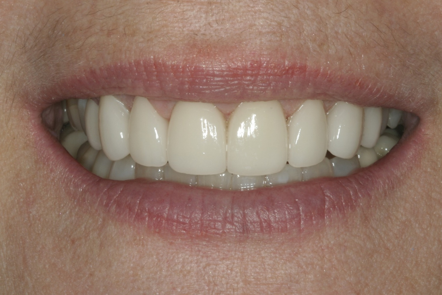 After: D.P.'s smile restored