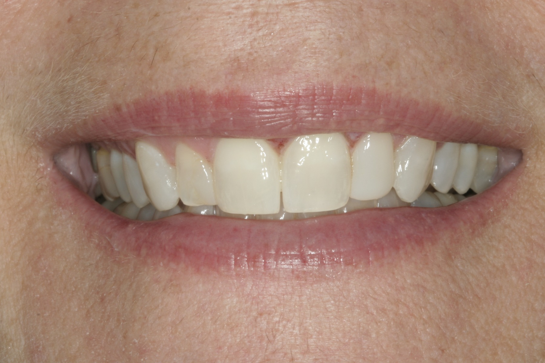 Before: D.P.'s smile