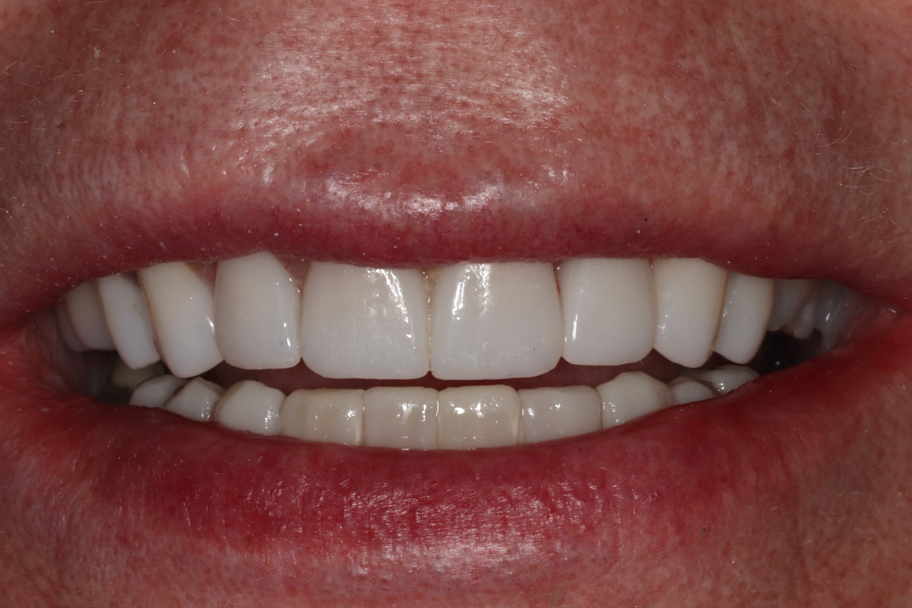After: D.P.'s smile restored