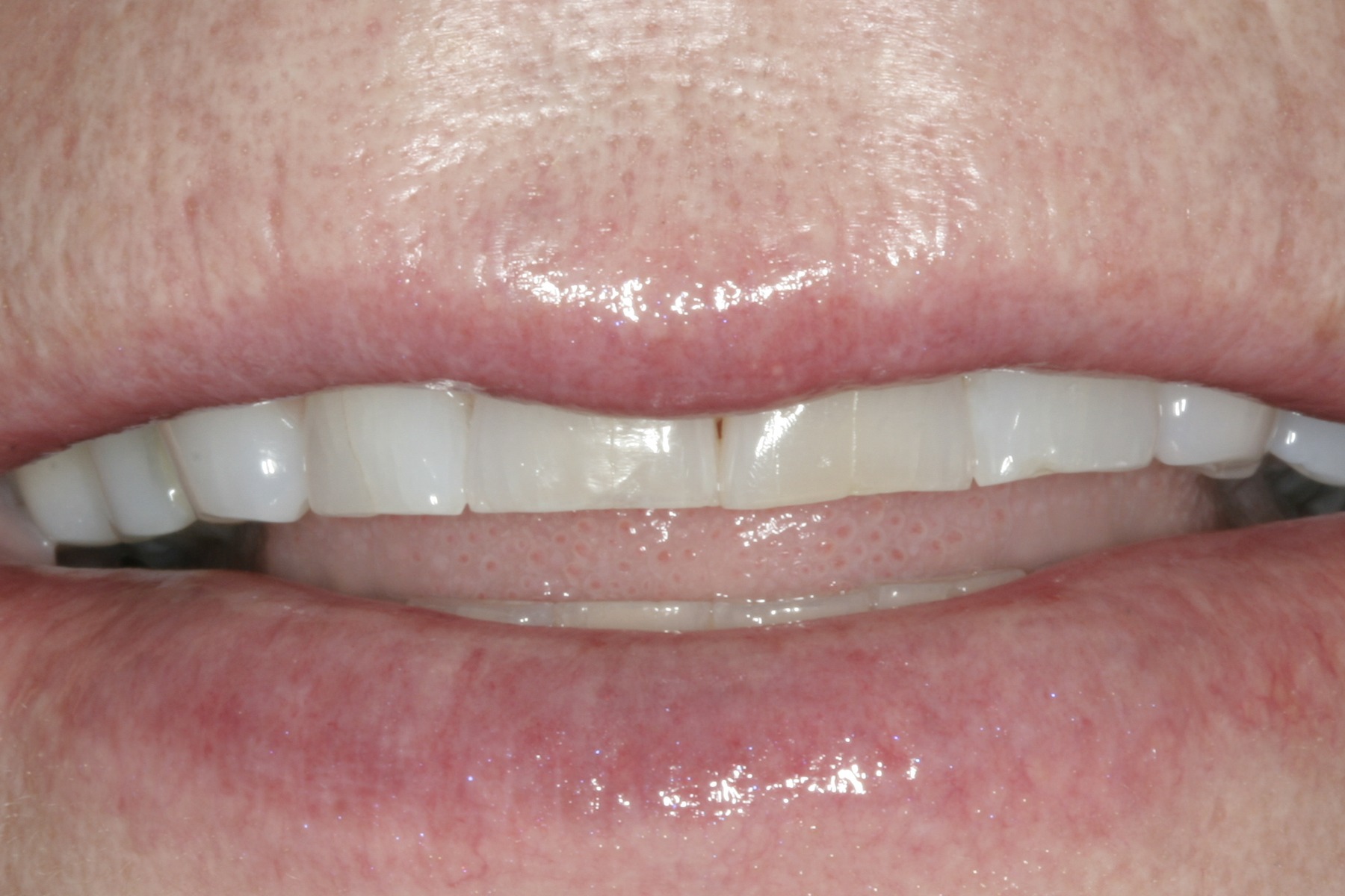 Before: D.P.'s smile