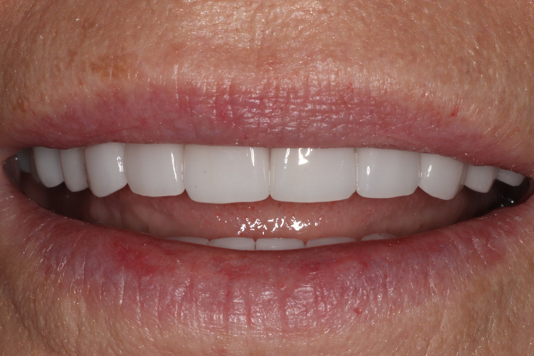 After: D.T.'s smile restored
