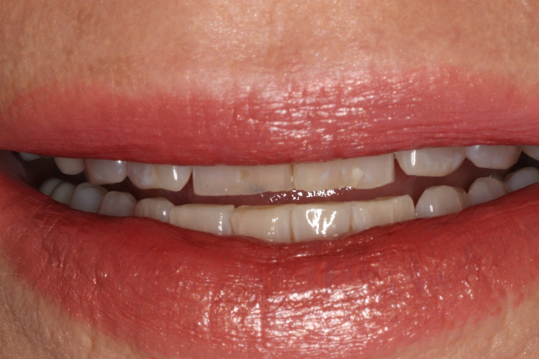 Before: D.T.'s smile