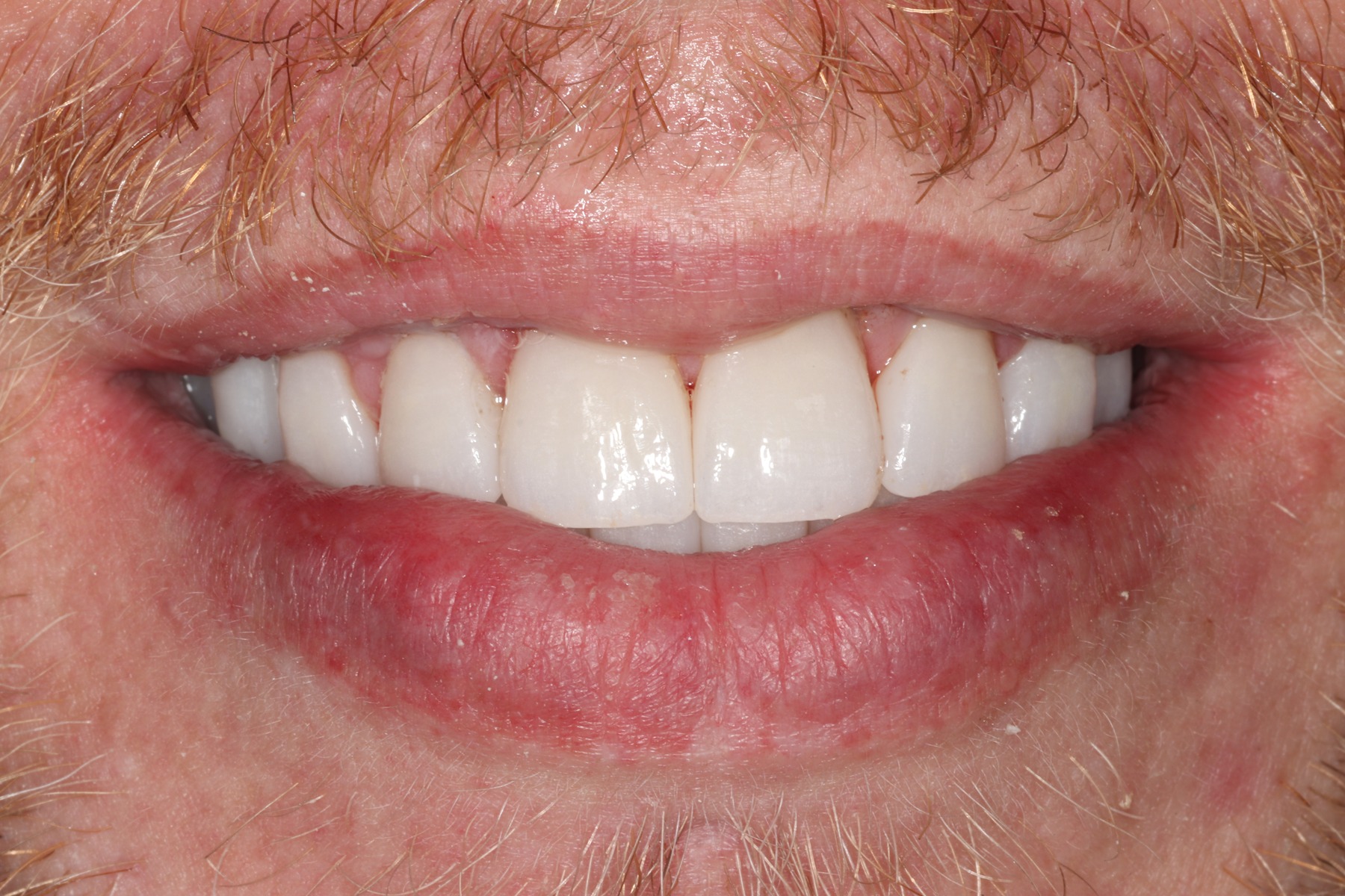 After: Derek's smile restored