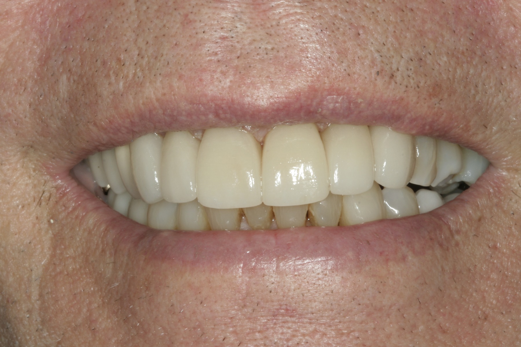 After: E.B.'s smile restored