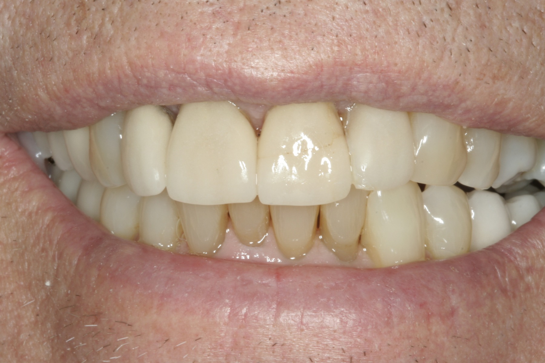 Before: E.B.'s smile