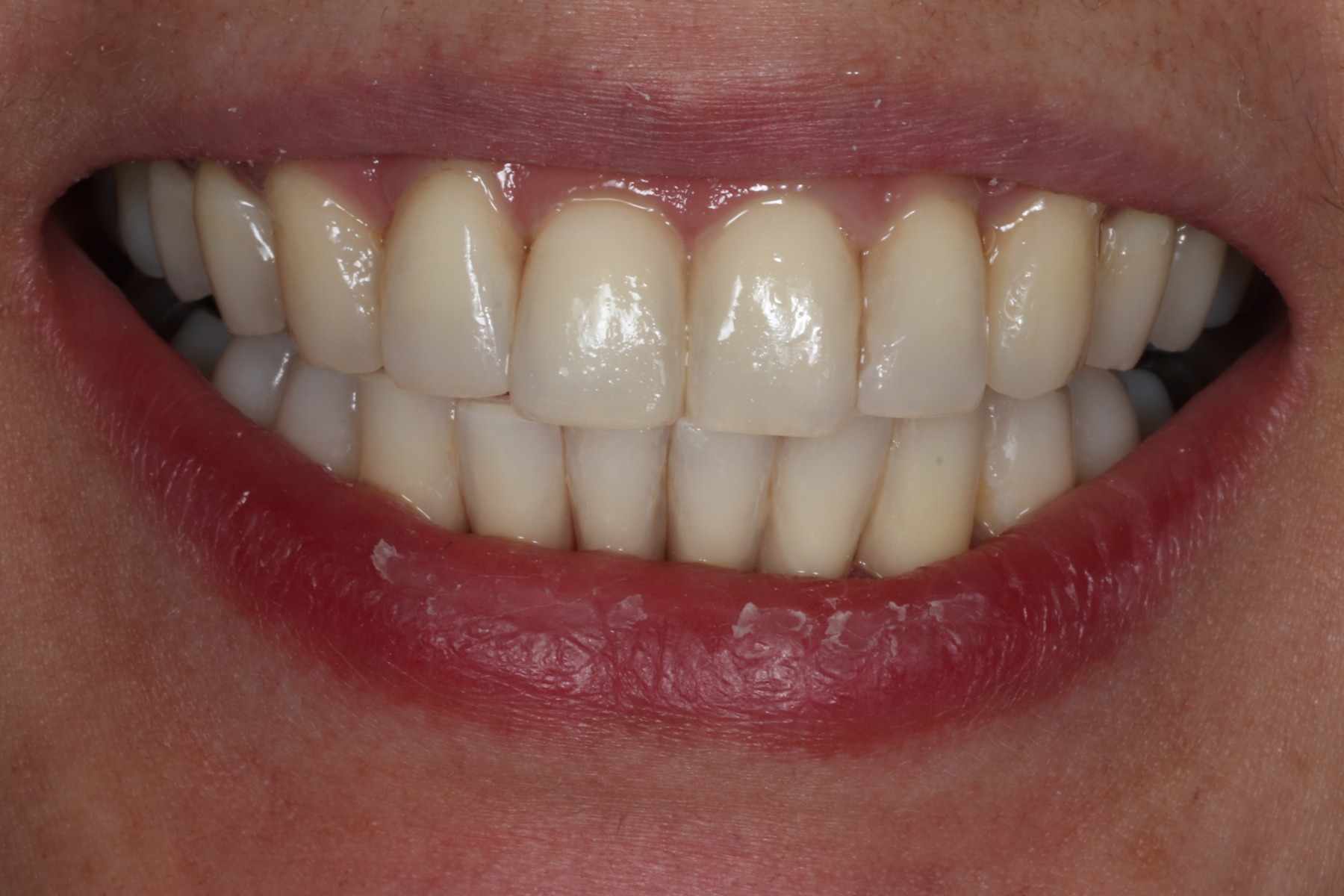 After: E.C.'s smile restored