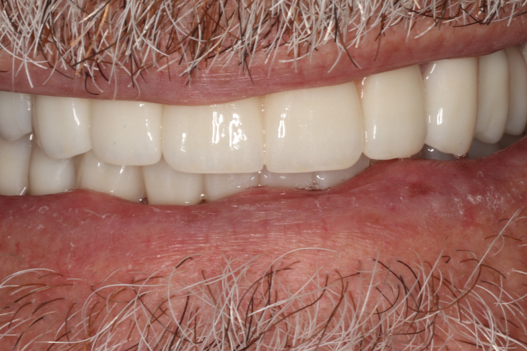After: G.B.'s smile restored