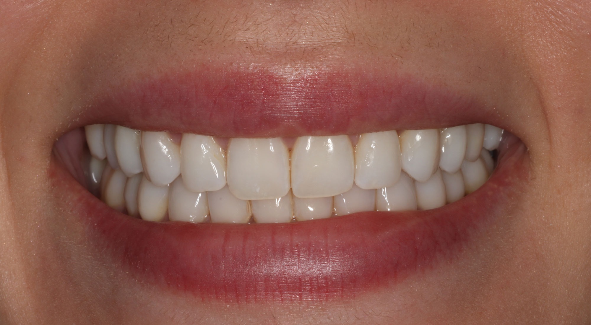 After: J.L.'s smile restored
