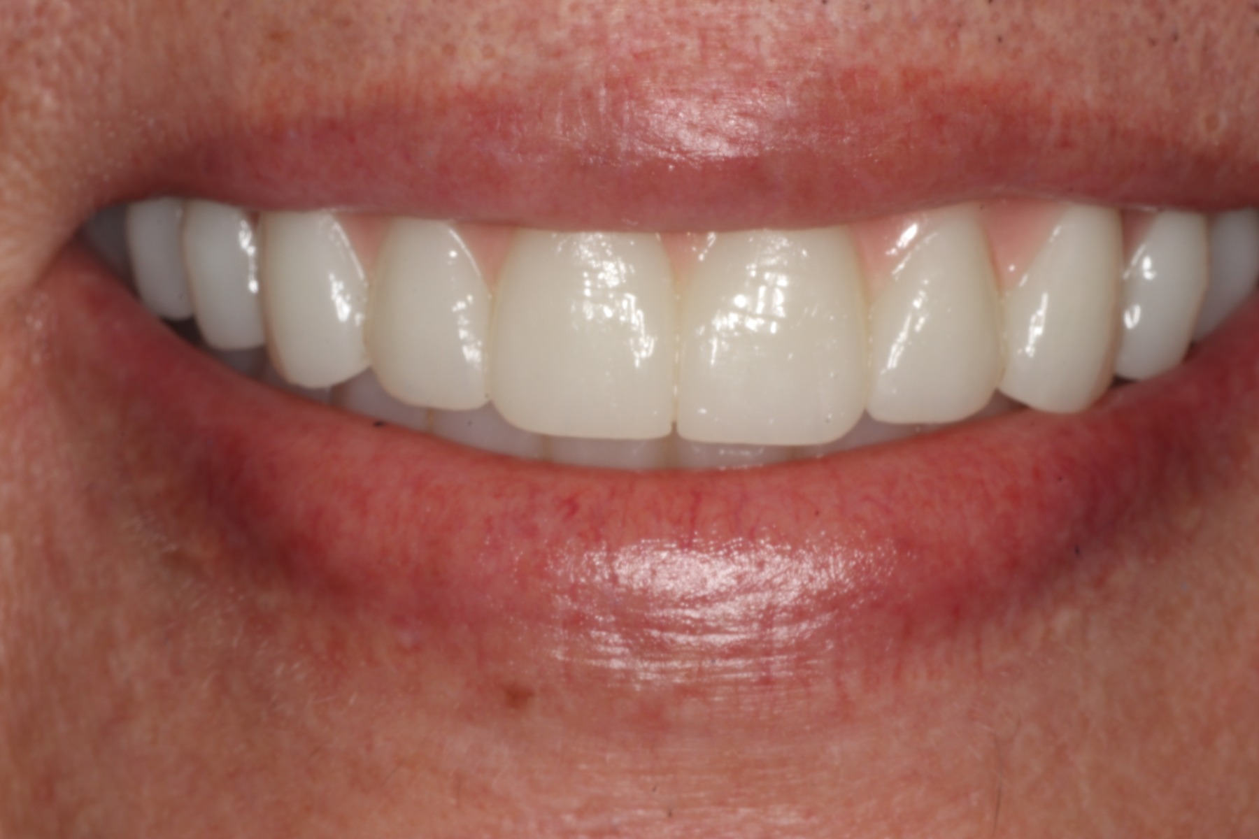 After: J.D.'s smile restored