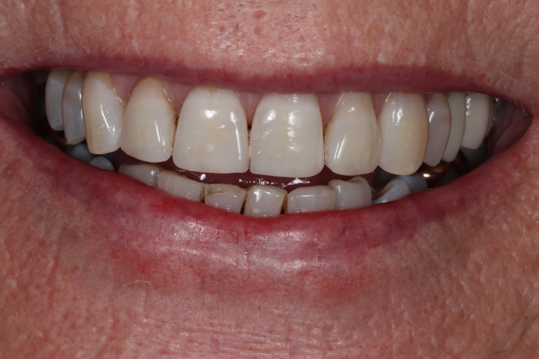 After: K.G.'s smile restored