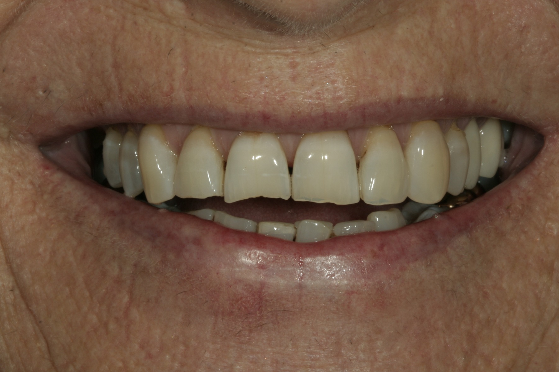 Before: K.G.'s smile