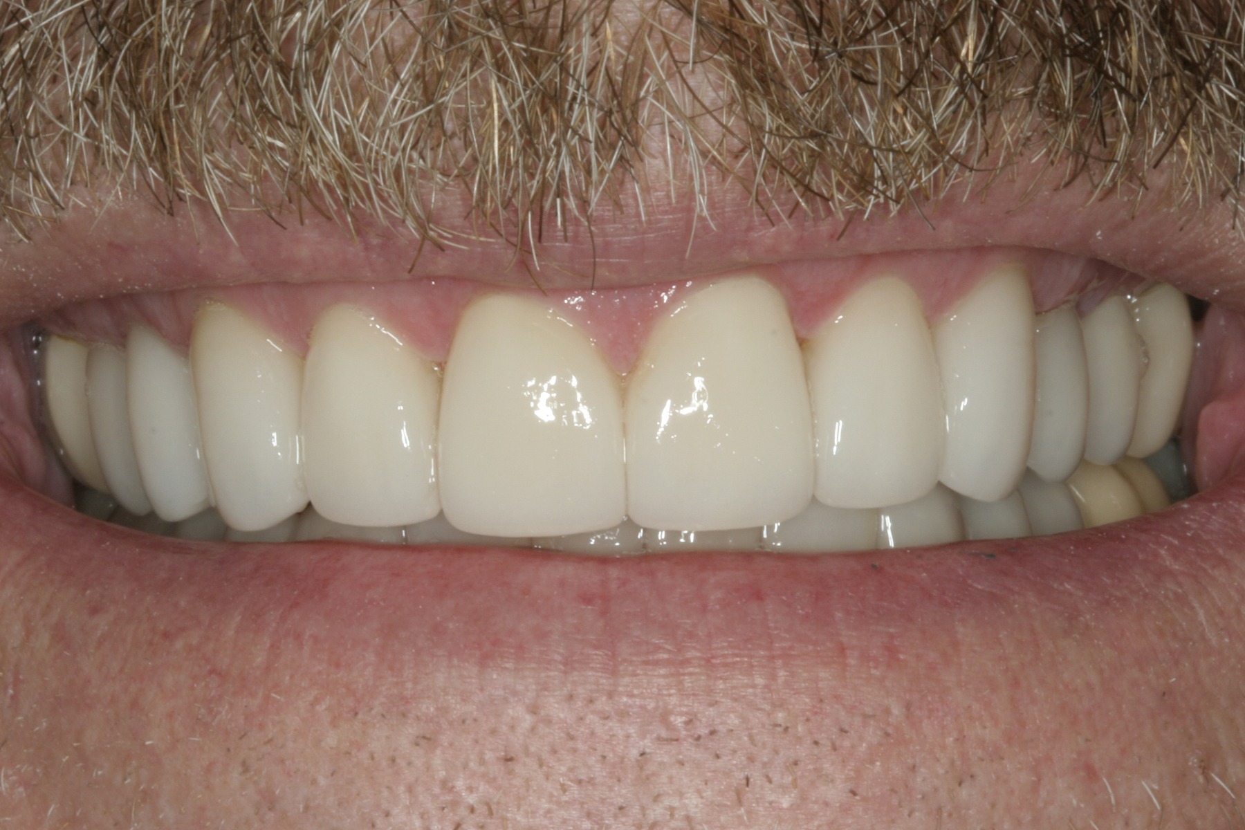 After: K.S.'s smile restored