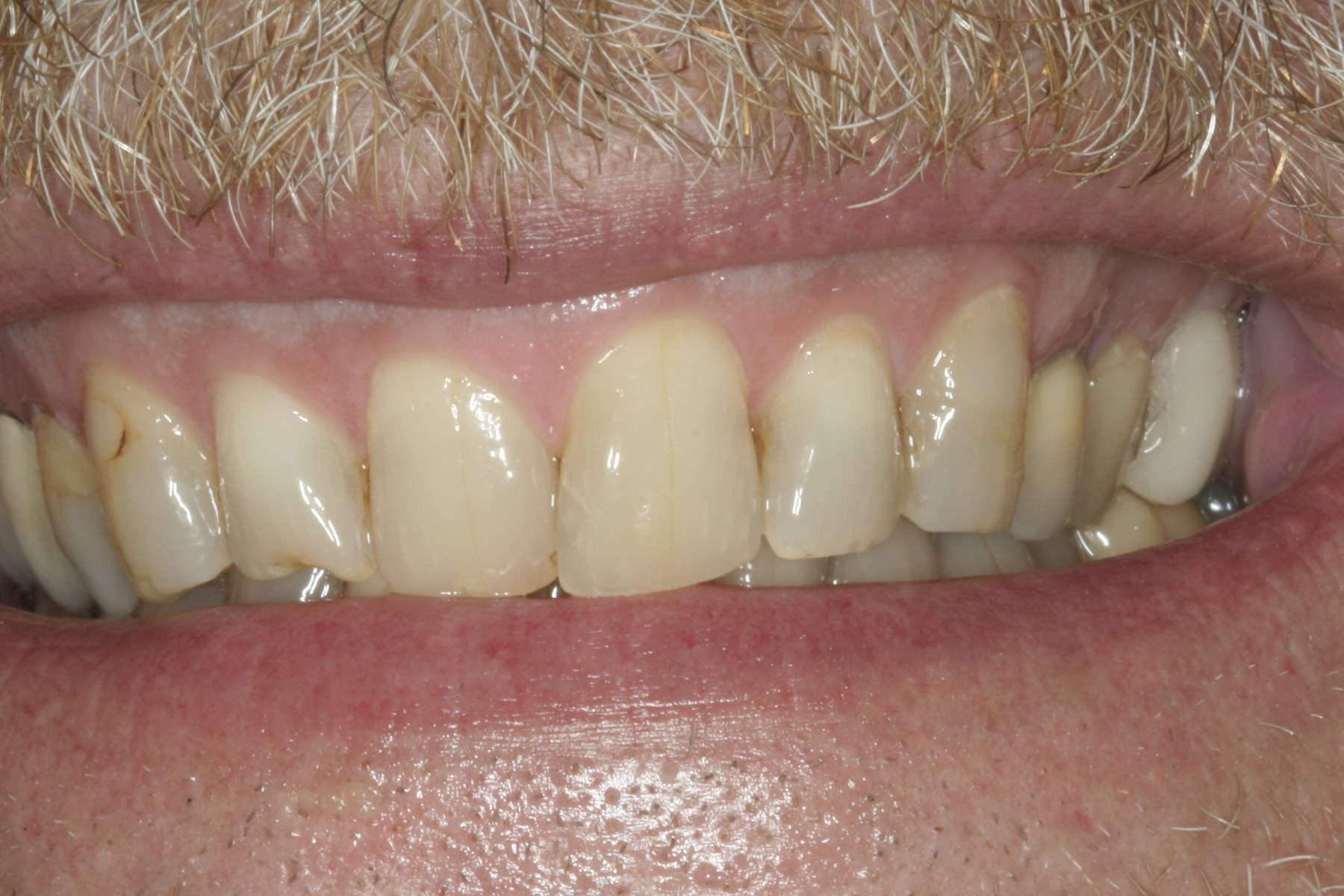 Before: K.S.'s smile