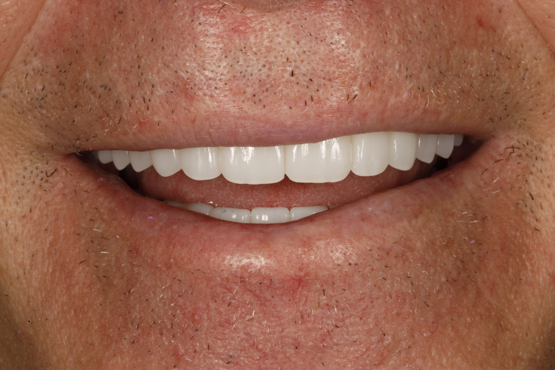 After: Kurt's smile restored