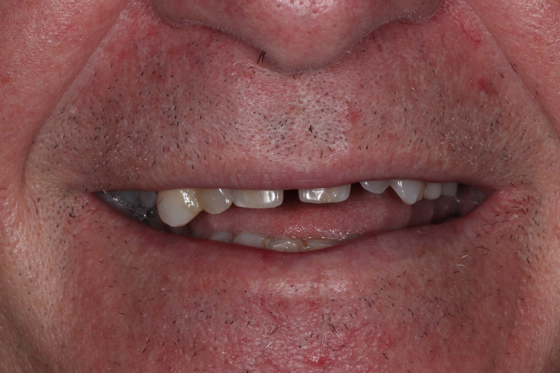 Before: Kurt's smile