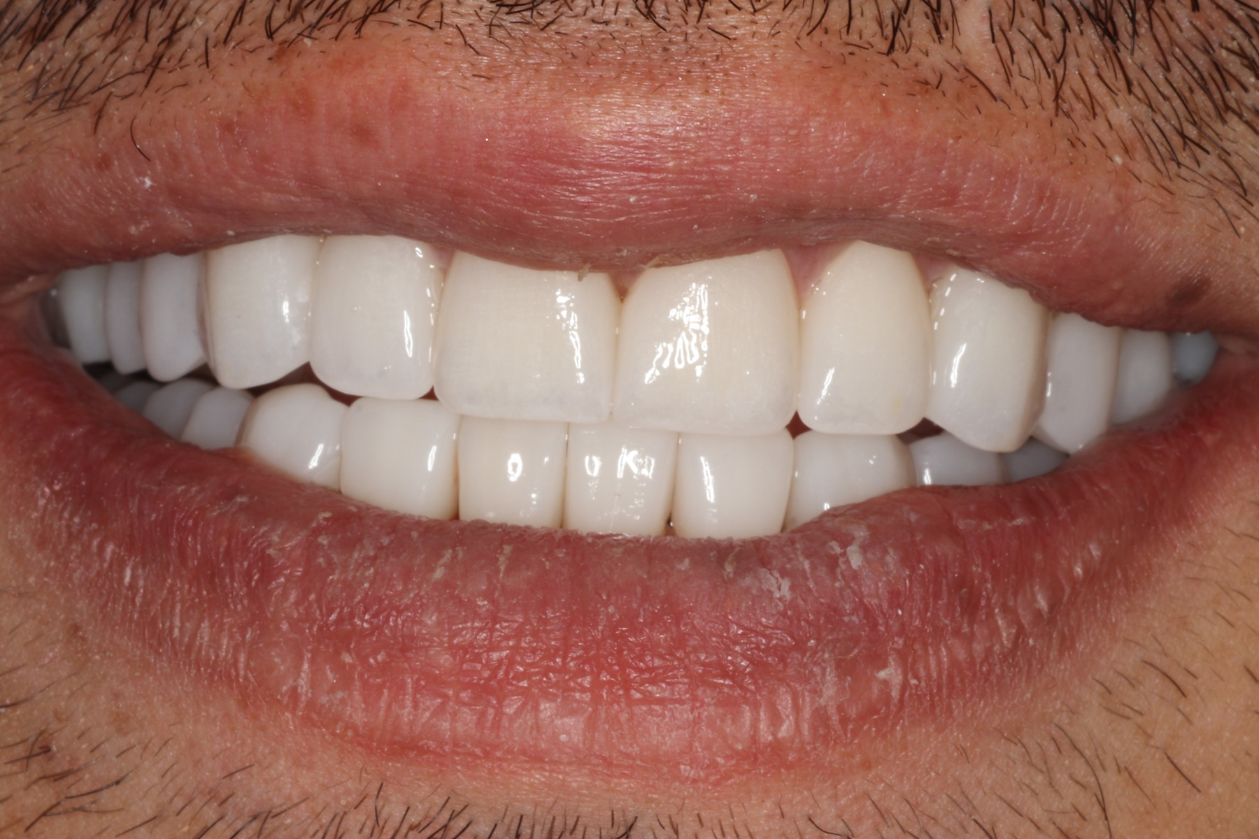 After: L.B.'s smile restored