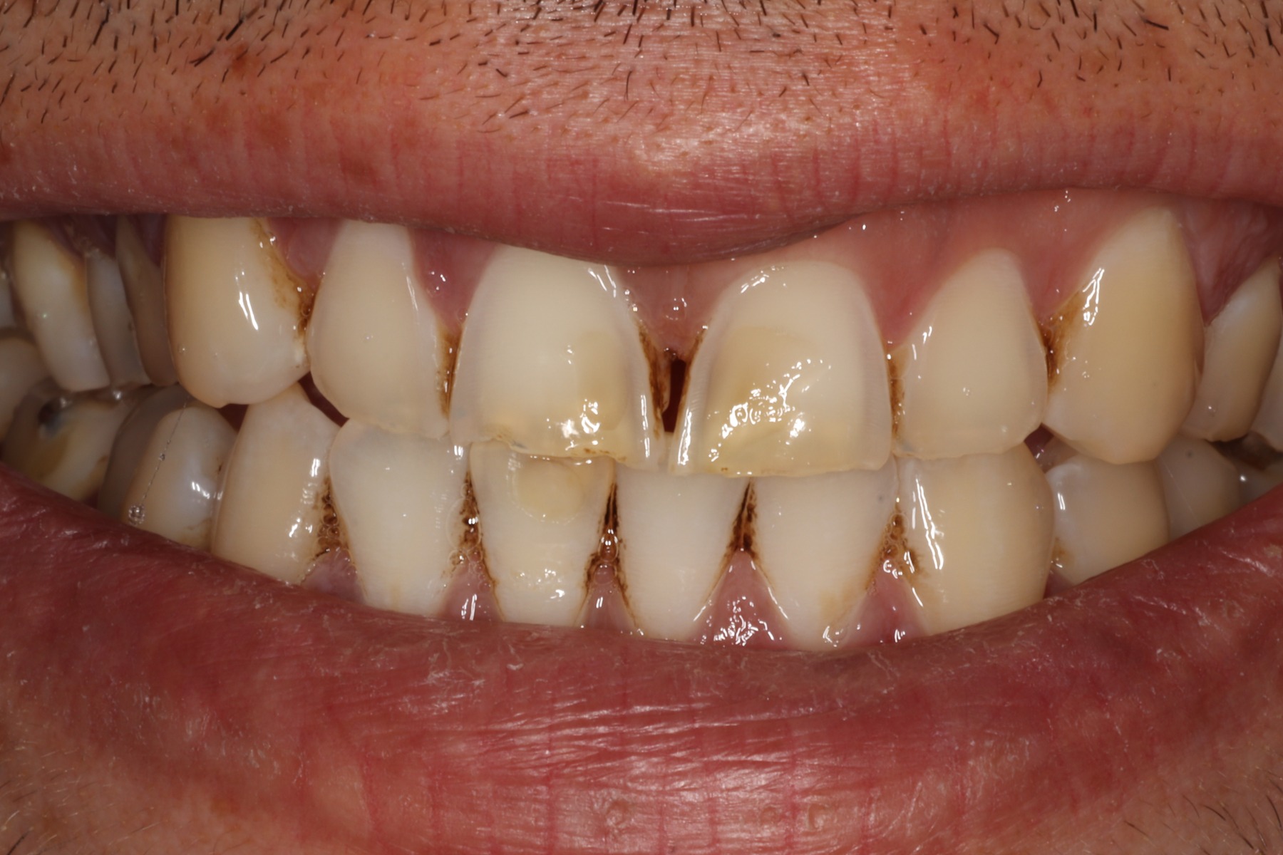 Before: L.B.'s smile