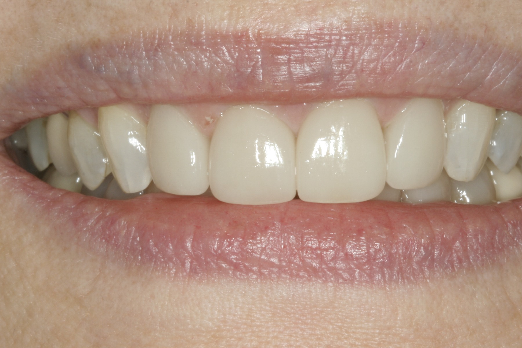 After: L.G.'s smile restored