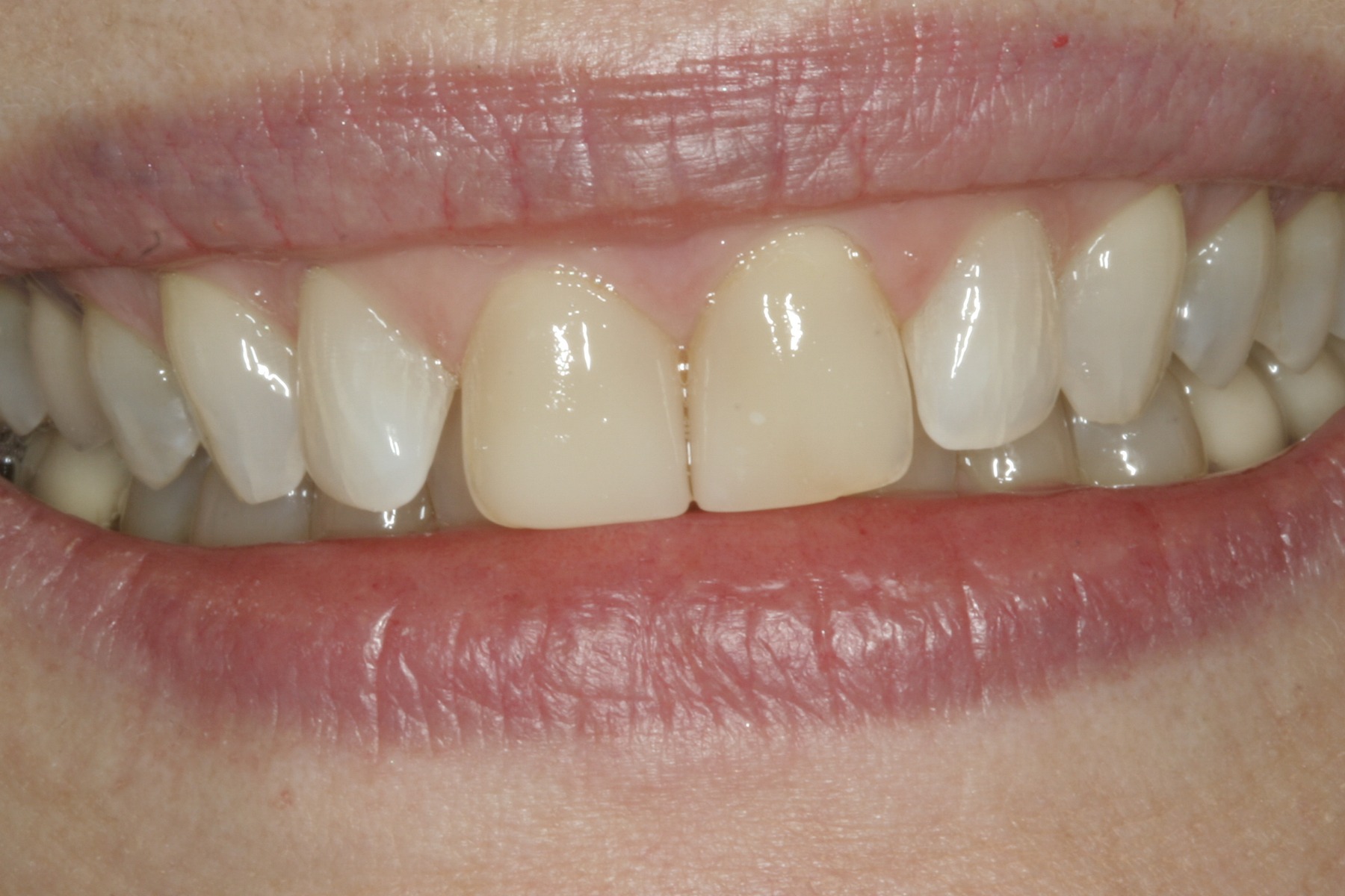 Before: L.G.'s smile